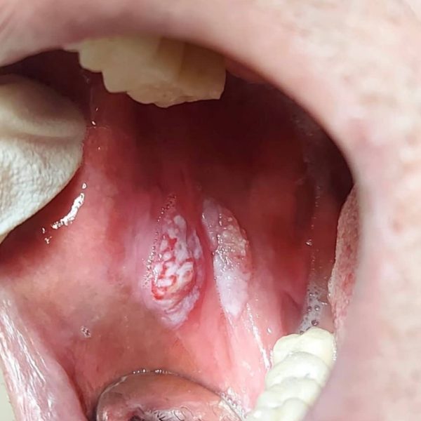 سرطان سلولهای سنگفرشی حفره دهان